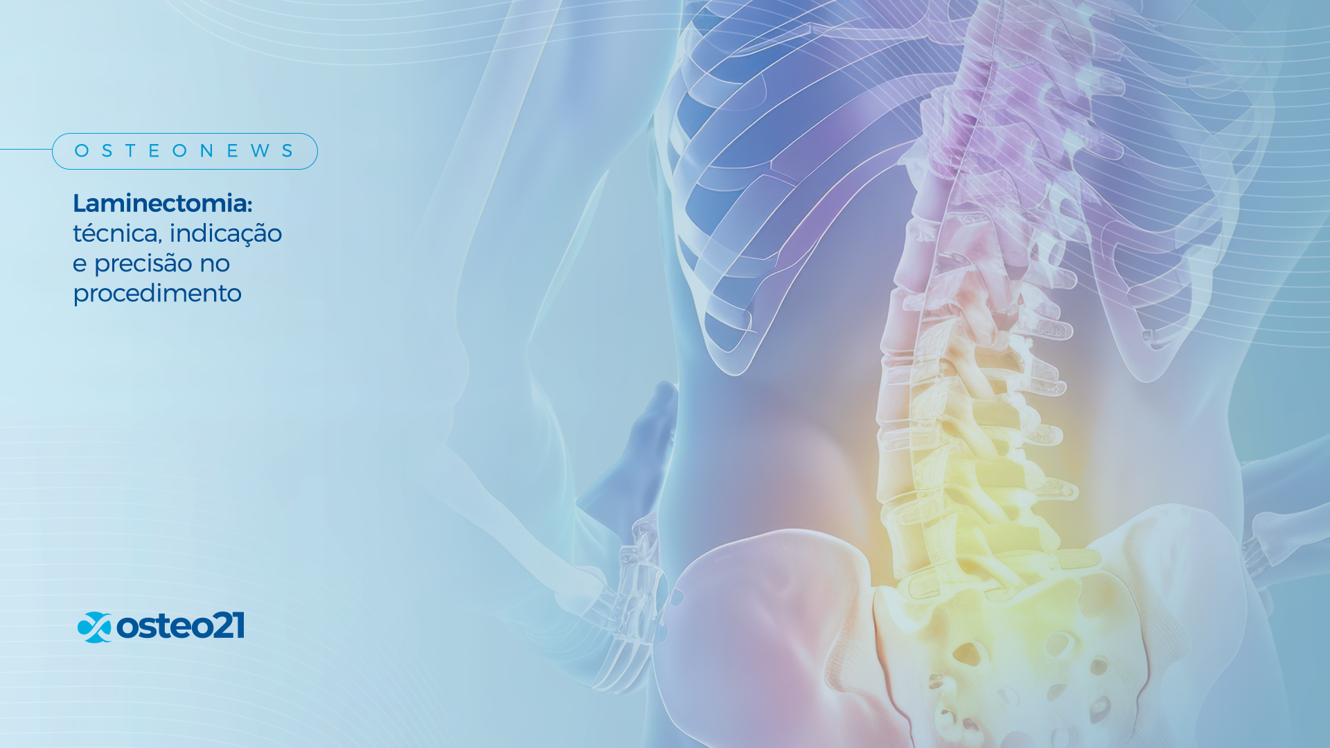 Laminectomia: técnica, indicação e precisão no procedimento